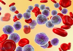 Tổng quan về bệnh Bạch Cầu Tủy Bào Cấp Tính – Ung thư máu cấp tính. (Acute Myeloid Leukaemia - AML)