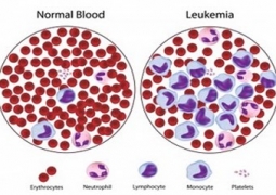 Tổng quan về bệnh Bạch Cầu Tủy Bào Mạn tính – Ung thư máu mạn tính  (Chronic Myeloid Leukaemia- CML)