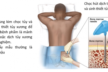 ĐA U TỦY XƯƠNG