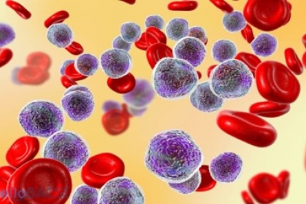 Tổng quan về bệnh Bạch Cầu Tủy Bào Cấp Tính – Ung thư máu cấp tính. (Acute Myeloid Leukaemia - AML)