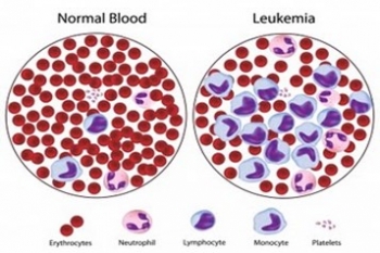 Tổng quan về bệnh Bạch Cầu Tủy Bào Mạn tính – Ung thư máu mạn tính  (Chronic Myeloid Leukaemia- CML)
