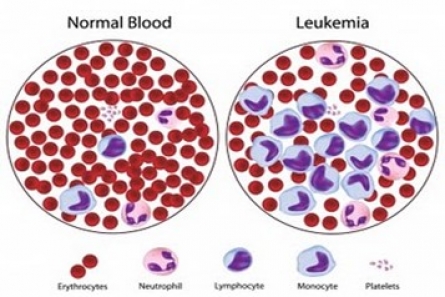 Tổng quan về bệnh Bạch Cầu Tủy Bào Mạn tính – Ung thư máu mạn tính  (Chronic Myeloid Leukaemia- CML)